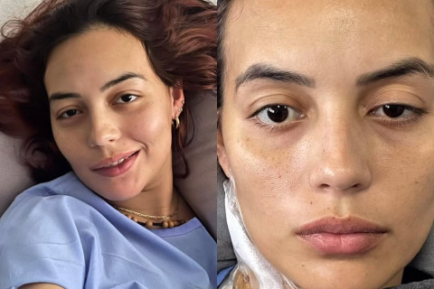 Mulher come sushi, contrai infecção grave, passa 23 dias na UTI e fica com paralisia facial