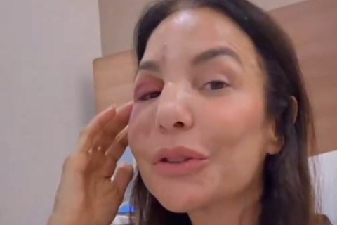 Cantora Ivete Sangalo fala sobre procedimento facial: "Quebrei dois Ossos"
