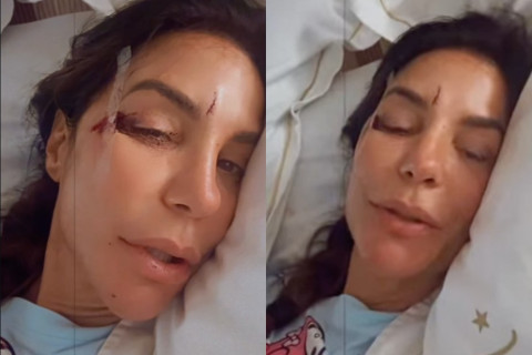 Ivete Sangalo aparece no hospital com ferimentos no rosto e relata susto após desmaio