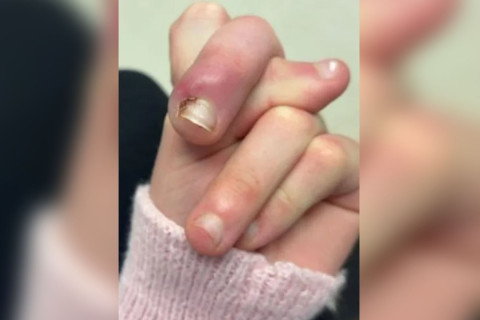 Jovem quase perde dedo após infecção causada por roer unhas