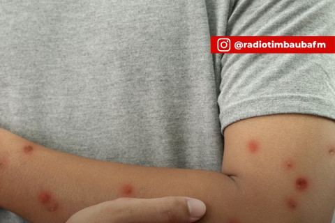 Brasil registra 88 casos confirmados de mpox; nenhum óbito até o momento