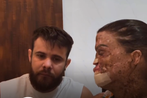 Influencer cearense com doença rara descobre câncer avançado nos ossos: "Posso ter só 6 meses de vida"