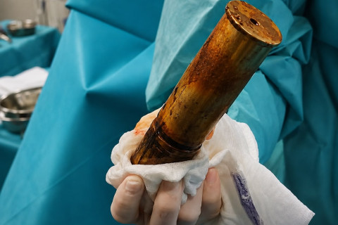 Homem com projétil de 20 cm da primeira guerra no reto mobiliza esquadrão antibombas em hospital