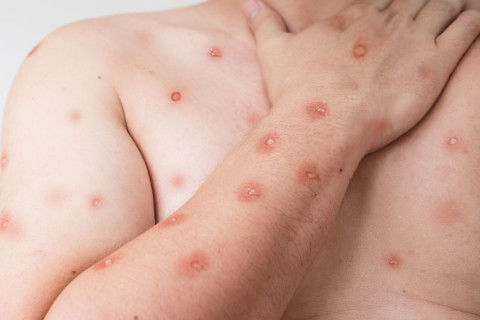 Ceará registra primeiro caso confirmado de Mpox em 2026